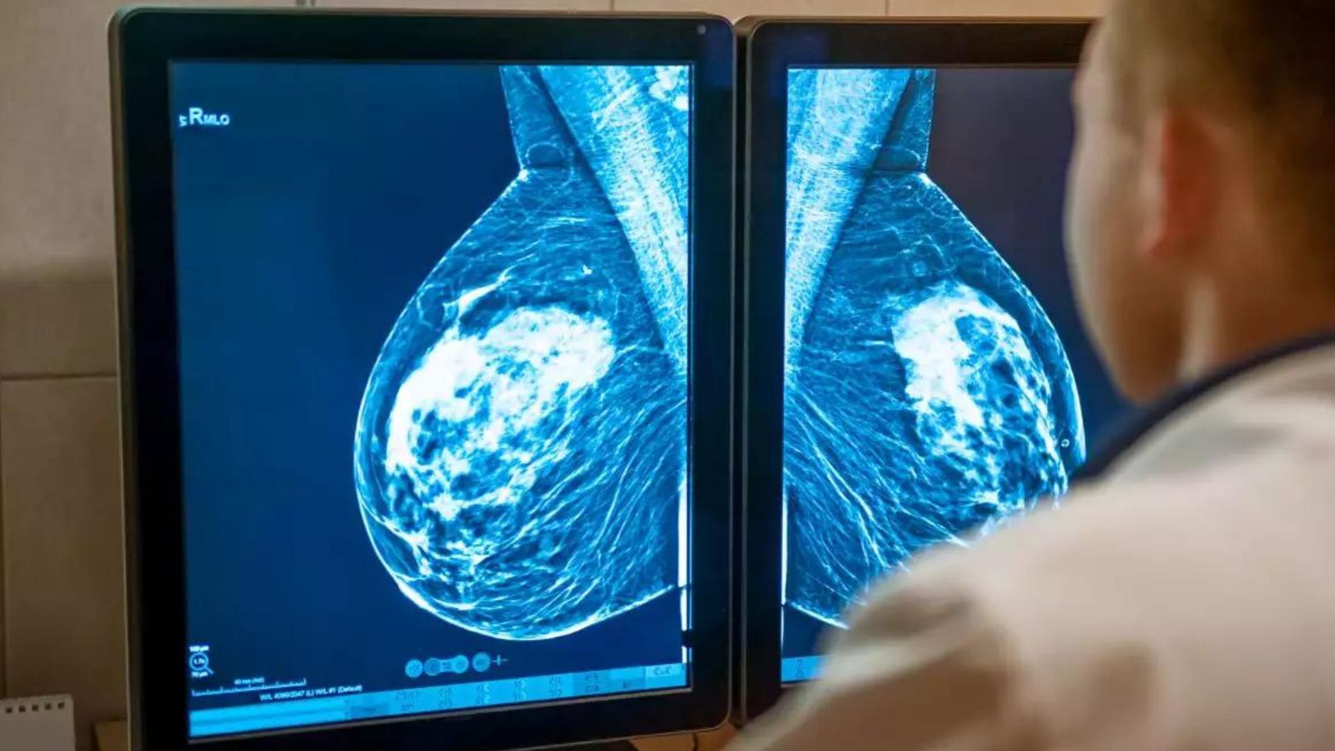 mamografias-antes-de-los-30-anos-son-necesarias-para-mujeres-con-alto-riesgo